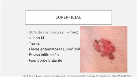 Carcinoma Basocelular Espinocelular Y Su Tratamiento Ppt