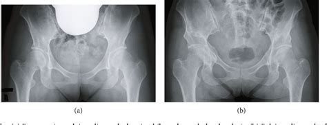 Figure From Sciatic Nerve Palsy Following Curved Periacetabular