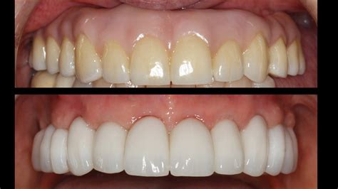 Fixed Bridges vs Fixed Dentures - The Complete Guide