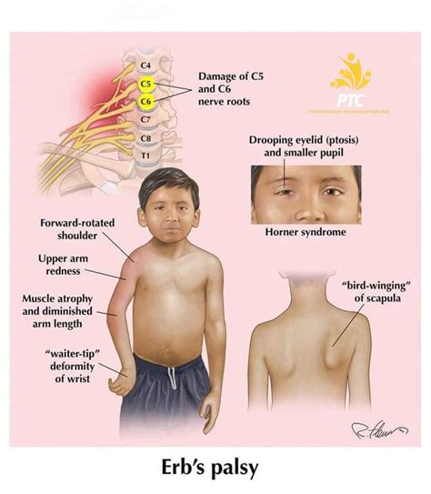 Klumpke's palsy is... - Physiotherapy techniques and cure