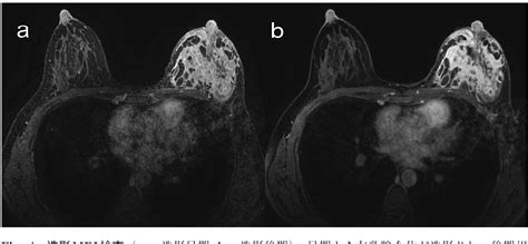 Figure From Granulomatous Mastitis With Erythema Nodosum In A Patient