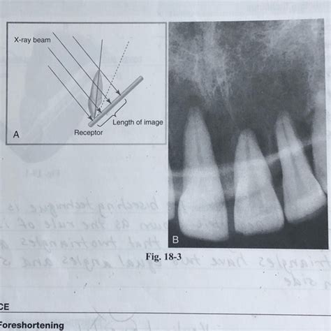 Oral Radiology Test Bisecting Technique Flashcards Quizlet