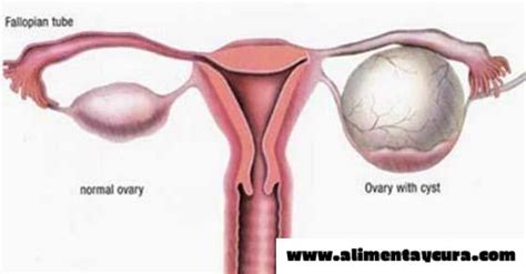 Limpia Los Quistes Del Ovario Con Las Mejores Recetas Alimenta Y Cura