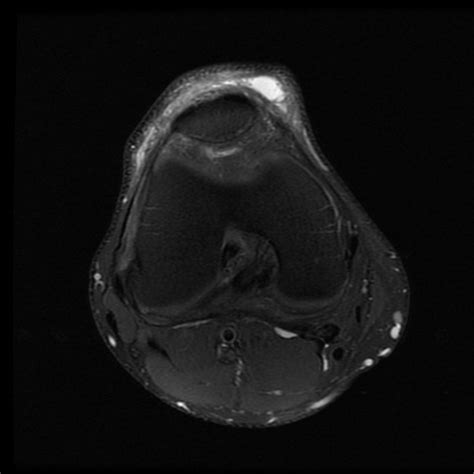 Prepatellar Bursitis Image