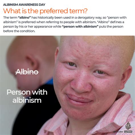 How Common Is Albinism And What Gene Causes It Infographic News Al