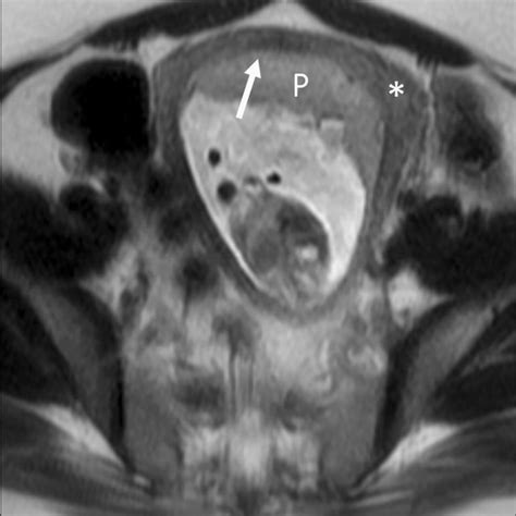 Placental Abruption A Illustration Of Different Locations Of Placental Download Scientific