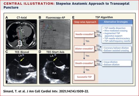 Anatomic Approach To Transseptal Puncture For Structural Heart