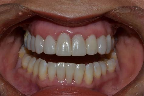 Carillas De Resina Cl Nica Dental Heredia Costa Rica