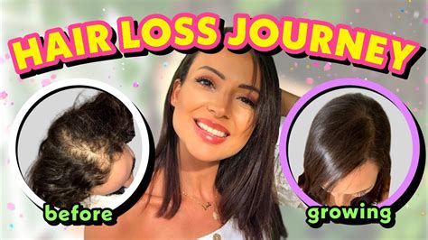 Hair Loss Treatment For Women My Female Hair Loss Journey Tips On Hair Loss Youtube