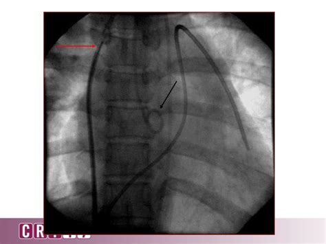 How To Perform A Successful Transseptal Puncture Zoltan