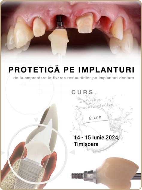 Curs Implantologie Curs Implanturi Dentare