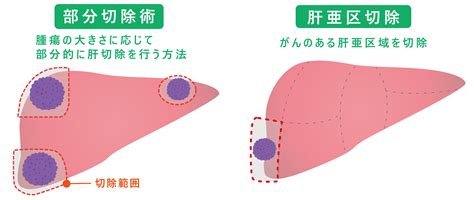 肝臓がん 加古川中央市民病院