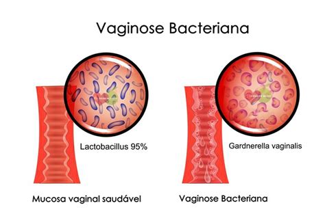 Vaginose Bacteriana O Que Sintomas E Tratamentos Dicas De Sa De