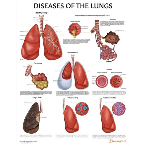 Diseases Of The Lung Anatomical Chart Poster Laminated Sexiz Pix Porn