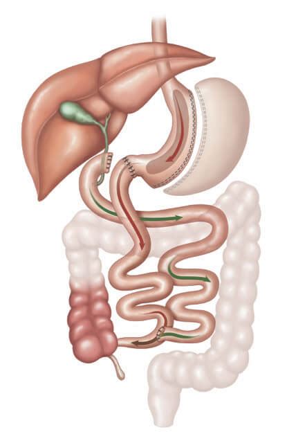 Sadi Or Single Anastomosis Duodenal Bypass Perth And Murdoch