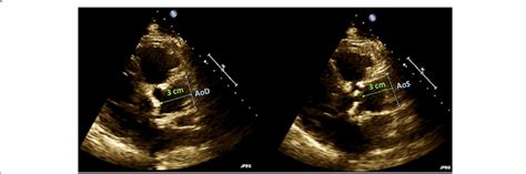 Ascending Aortic Diameter Measurements Ascending Aortic Diameters Were