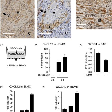 Analysis Of CXCL12 Expression In Primary OSCC Tissues A B