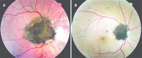 Clinical Appearance Of Optic Disk Melanocytoma In The Described Download Scientific Diagram