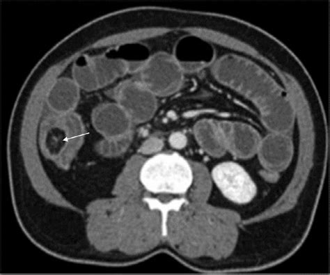 Axial Ct Scan Showing A Well Circumscribed Intraluminal Hypodense