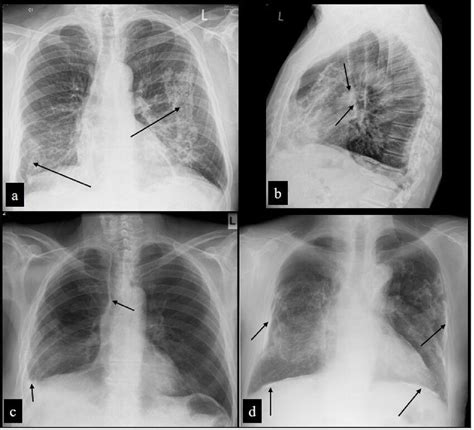 Images Showing Asbestos Related Diseased Tissues A B Frontal And