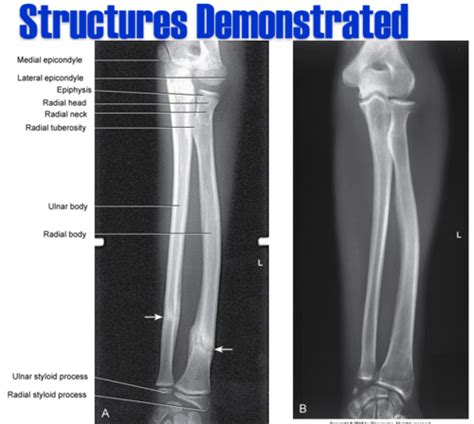 Ch 5 Humerus Shoulder And Clavicle Flashcards Quizlet