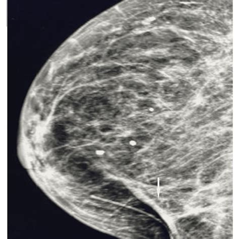 Spot Compression Diagnostic Mammogram Mlo View At The Time Of