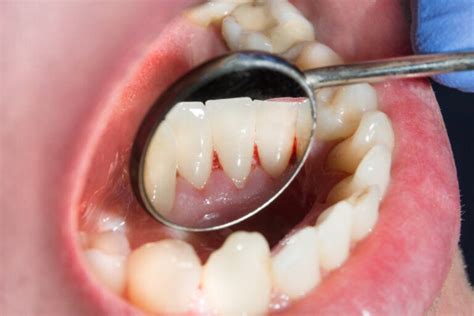 Cirugía periodontal causas y proceso de recuperación Mejor con Salud