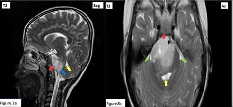 Intracranial Tumor Presenting As Raymond Syndrome In A Pediatric