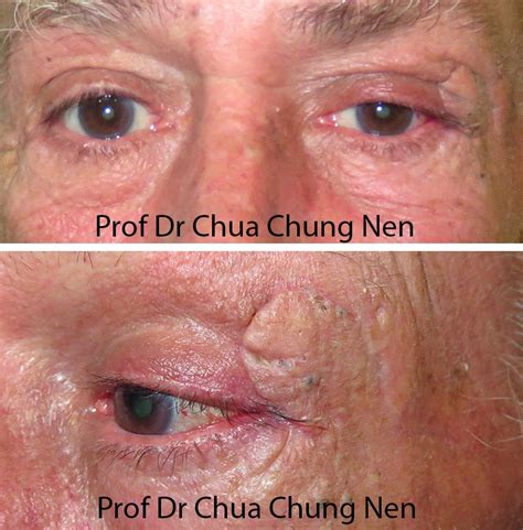 Eyelid Surgery by Prof Dr CN CHUA 蔡鐘能: A Rapidly Enlarging Upper Eyelid Lesion