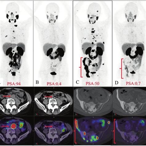 Re Treatment With 177 Lu PSMA RNT Pretreatment PSMA PET CT Images A