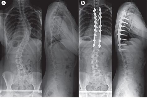 Scoliosis Xray before and after surgery