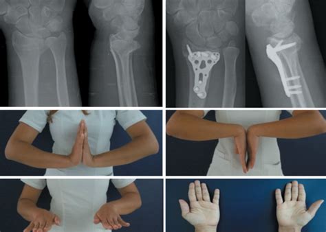 Nueva T Cnica Para Correcci N De Mal Uni N De Radio Distal Osteotom A