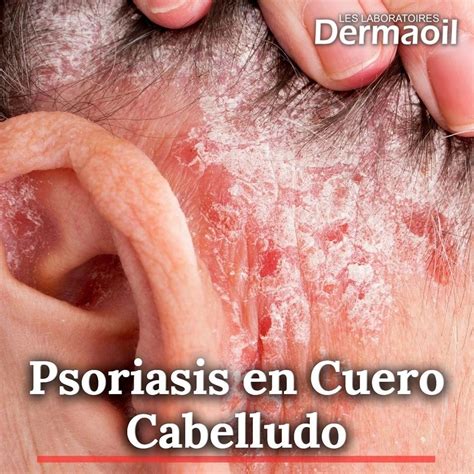 Psoriasis En Cuero Cabelludo