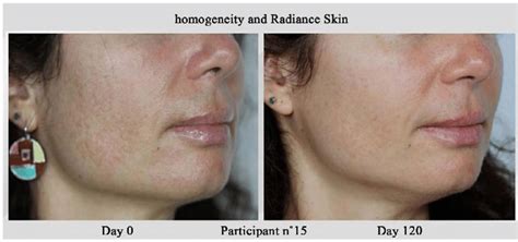 Comparison Of Homogeneity And Skin Radiance Before And After Treatment