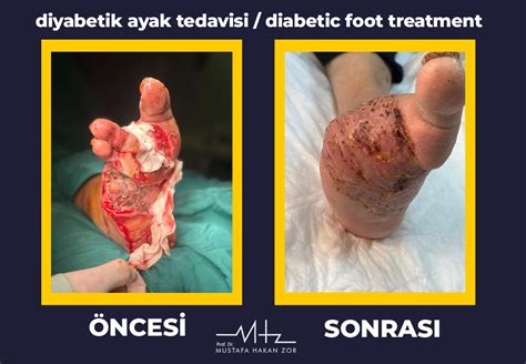 Diabetic Foot Wounded Foot Treatment Prof Dr Mustafa Hakan Zor