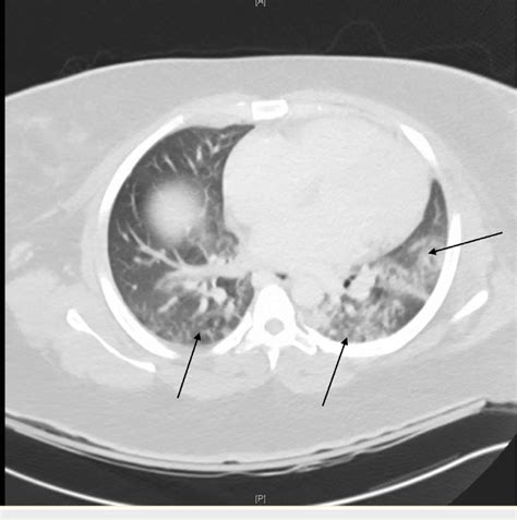 Computed Tomography CT Scan Of The Chest Showing Bilateral Patchy