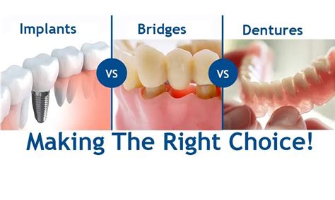 Dental Implants Vs Partial Dentures Making The Right Choice For Your