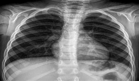 Plain chest x-ray (antero-posterior view) showing perihilar densities... | Download Scientific ...