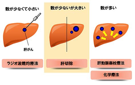 肝細胞がん 大阪赤十字病院がん診療センター