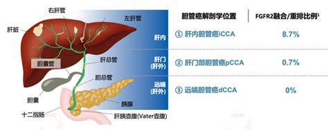 胆管癌治疗破冰：fgfr抑制剂佩米替尼开启精准治疗之门凤凰网区域凤凰网