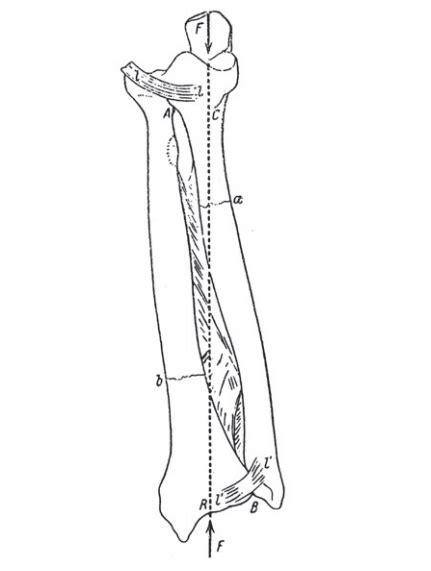 Galeazzi fracture • LITFL • Medical Eponym Library