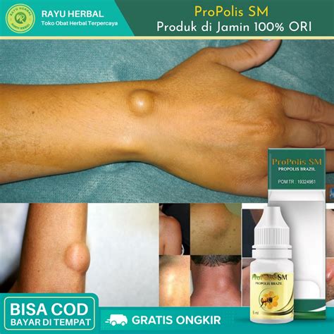 Jual Obat Penghilang Benjolan Tumor Jinak Lipoma Di Tangan Leher