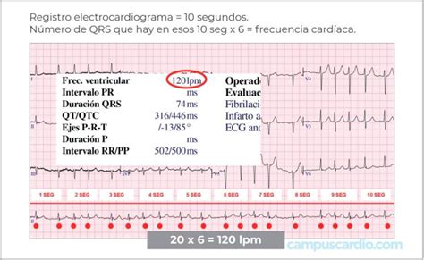 Cálculo Rápido De La Frecuencia Cardíaca Campuscardio