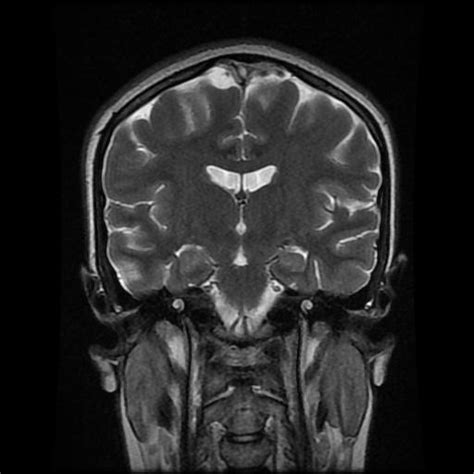 Superior Sagittal And Right Transverse Sinuses Thrombosis Image