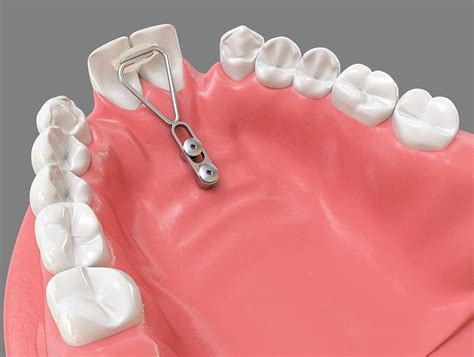 benefit palatal tads orthomax australia