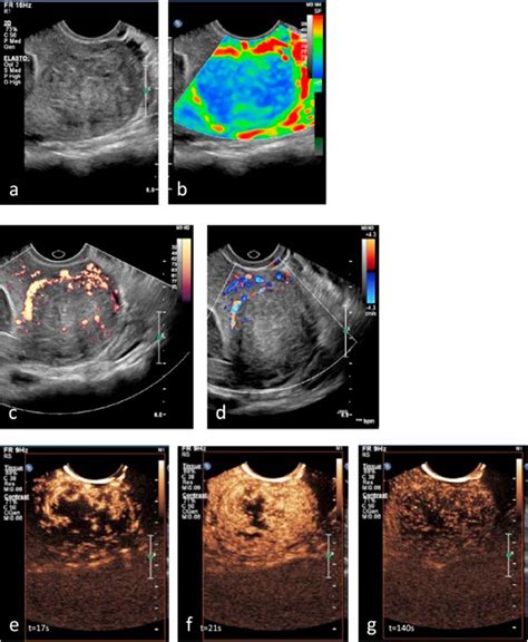 Contrast Enhanced Ultrasound For Monitoring Non Surgical Treatments Of