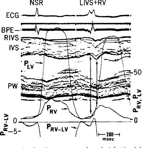 Figure From Mechanism Of Abnormal Interventricular Septal Motion