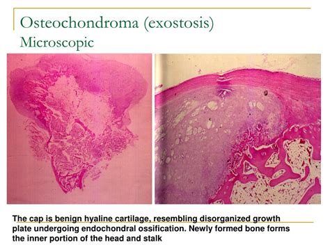 Ppt Bone Tumors Powerpoint Presentation Free Download Id 198433