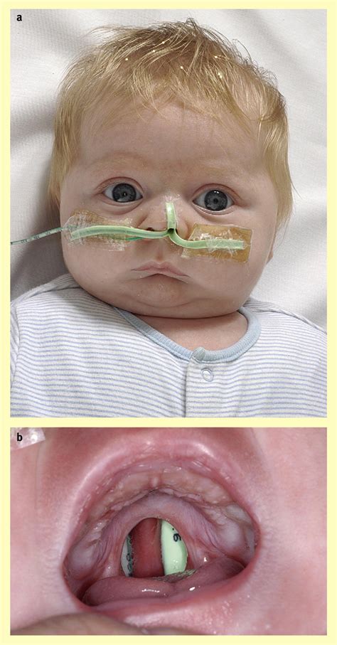 Cleft Lip And Palate Current Management Paediatrics And Child Health