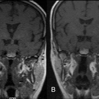 A Preoperative Cranial Non Contrast Axial CT Showed A Residual Tumor